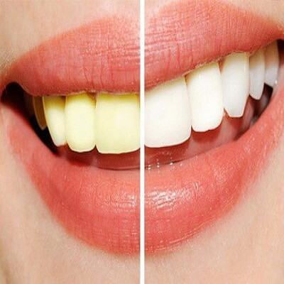 Những cách làm trắng răng làm một lần đã thấy kết quả rõ rệt 3