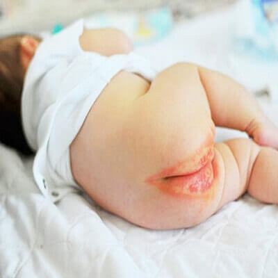 Lạm dụng việc mặc bỉm có thể gây hại đến vùng kín của trẻ 4