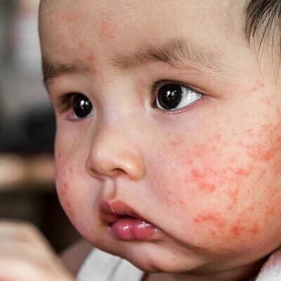 Trẻ sơ sinh nổi mẩn đỏ và cách chăm sóc tốt nhất 3