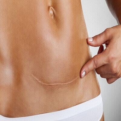Sau sinh, vết mổ đẻ bao lâu thì lành hẳn? 4