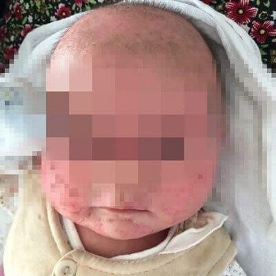 Trung Quốc: Trẻ nhiễm viêm màng não chỉ vì nụ hôn của mẹ 5