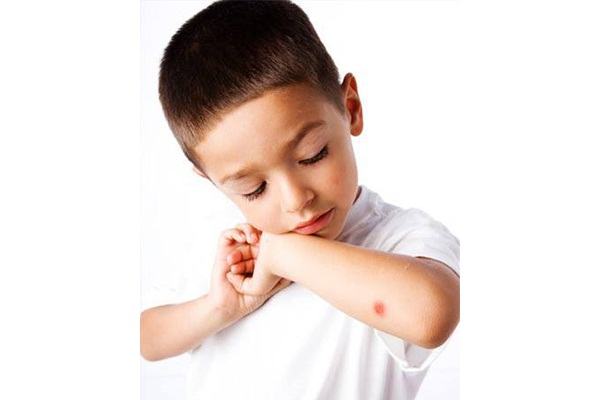7 mẹo trị lành sẹo do côn trùng gây ra cho bé 7