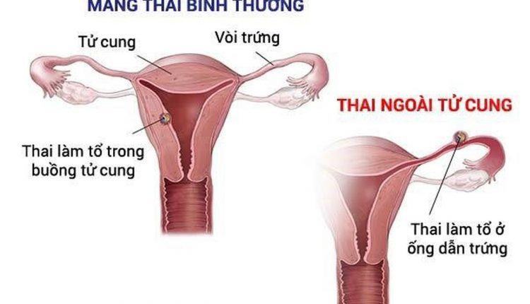 Chửa ngoài dạ con nguy hiểm như thế nào, mẹ đã biết chưa? 34 Chửa ngoài dạ con nguy hiểm như thế nào, mẹ đã biết chưa? 6