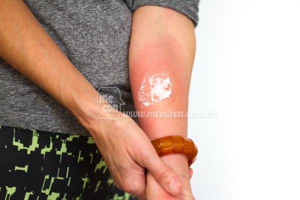 Dị ứng mẩn ngứa do đeo trang sức và cách khắc phục 15 Dị ứng mẩn ngứa do đeo trang sức và cách khắc phục 5