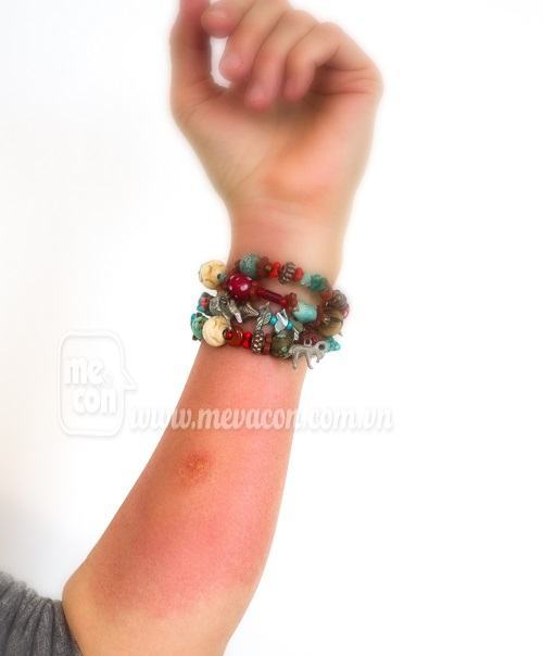 Dị ứng mẩn ngứa do đeo trang sức và cách khắc phục 14 Dị ứng mẩn ngứa do đeo trang sức và cách khắc phục 4