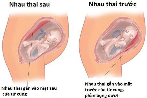 Nhau thai bám mặt trước, đừng lơ là 4