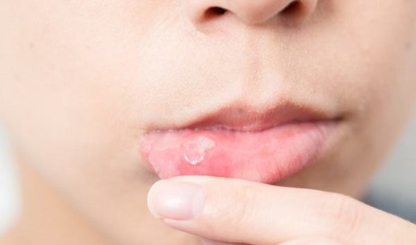Bị nhiệt miệng nhiều lần liên tục có thể do 4 nguyên nhân chính sau đây 3