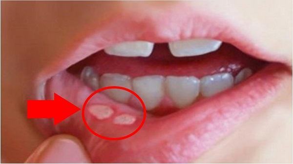 Mách mẹ cách trị nhiệt miệng cho trẻ hiệu quả 4