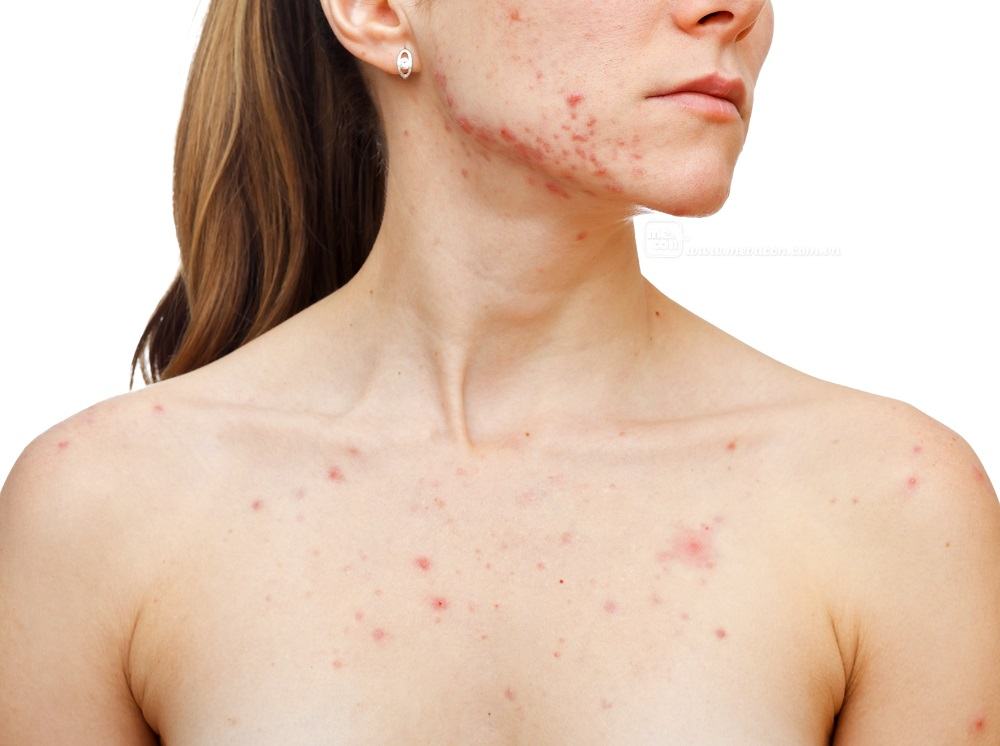 Cách trị nóng trong người nổi mụn