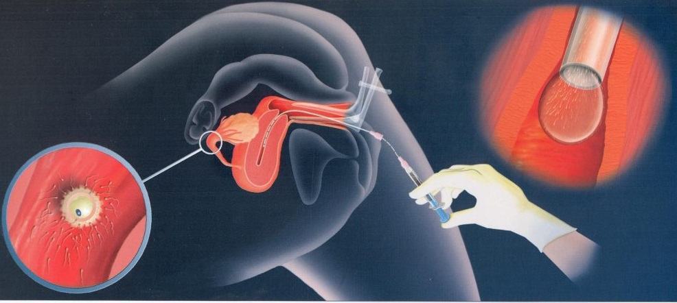 Vợ chồng hiếm muộn con phải làm sao? 38 hiếm muộn con phải làm sao