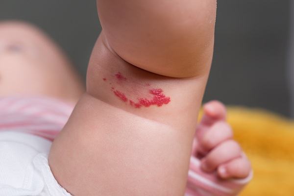 Vết bớt nói lên điều gì về số phận sau này của trẻ nhỏ 35 Vết bớt nói lên điều gì về số phận sau này của trẻ nhỏ 7