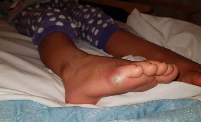 Bé gái 4 tuổi bị nhiễm trùng máu sau khi đi thử giày ở cửa hàng 7