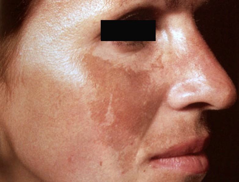 Trị nám da sau sinh, đừng mắc những sai lầm này 33 trị nám da sau sinh