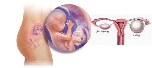 U nang buồng trứng khi mang thai nguy hiểm cho cả mẹ và bé 36 u nang buồng trứng khi mang thai