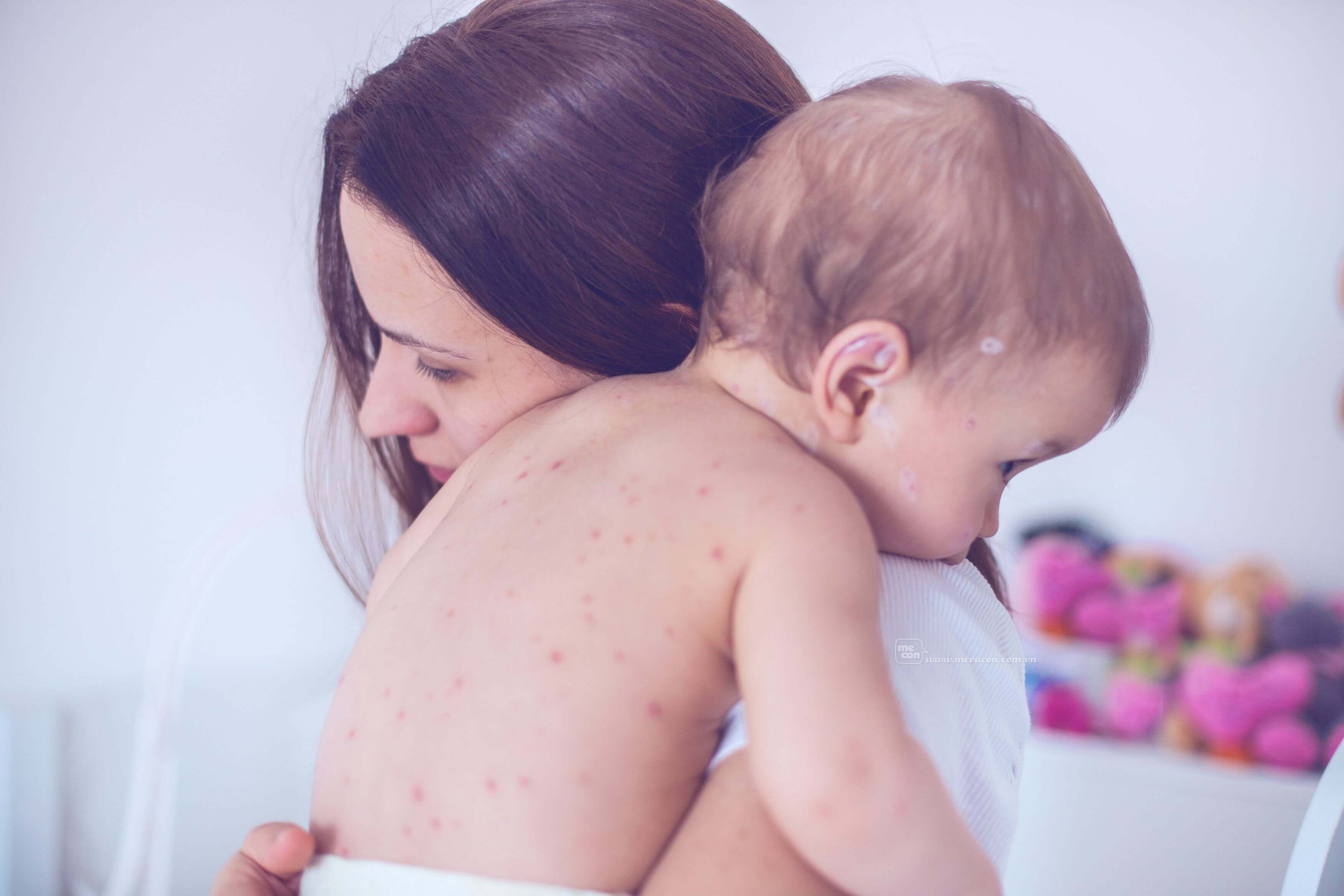 Dấu hiệu sởi ở trẻ nhỏ, mẹ đừng nhầm lẫn với sốt phát ban 33 dấu hiệu sởi ở trẻ nhỏ