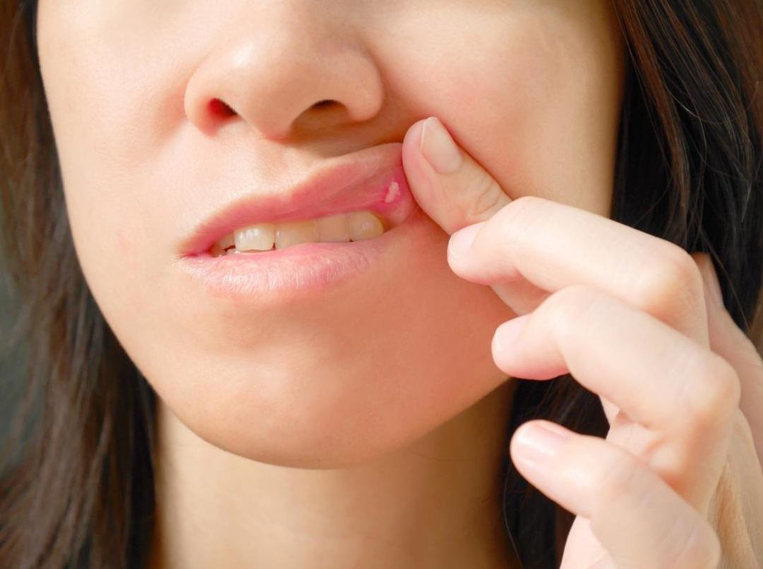 Bật mí 9 cách chữa lỡ miệng đơn giản mà không cần thuốc 3