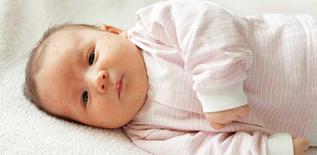 Mụn sữa ở trẻ sơ sinh và những điều mẹ nên biết 5