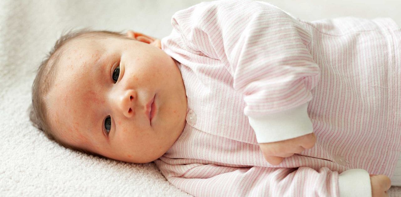 Mụn sữa ở trẻ sơ sinh và những điều mẹ nên biết 6