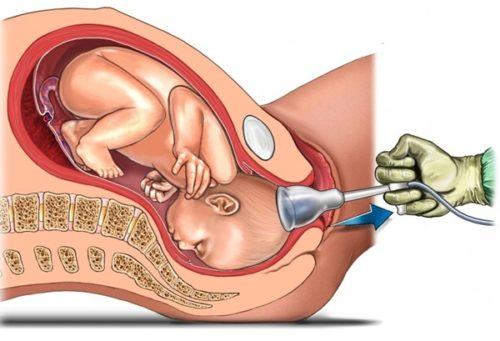 Sinh con bằng giác hút có ảnh hưởng gì đến trẻ? 35 trường hợp sinh con bằng giác hút