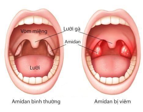 Giao mùa, cẩn thận viêm Amidan 33 viêm Amidan
