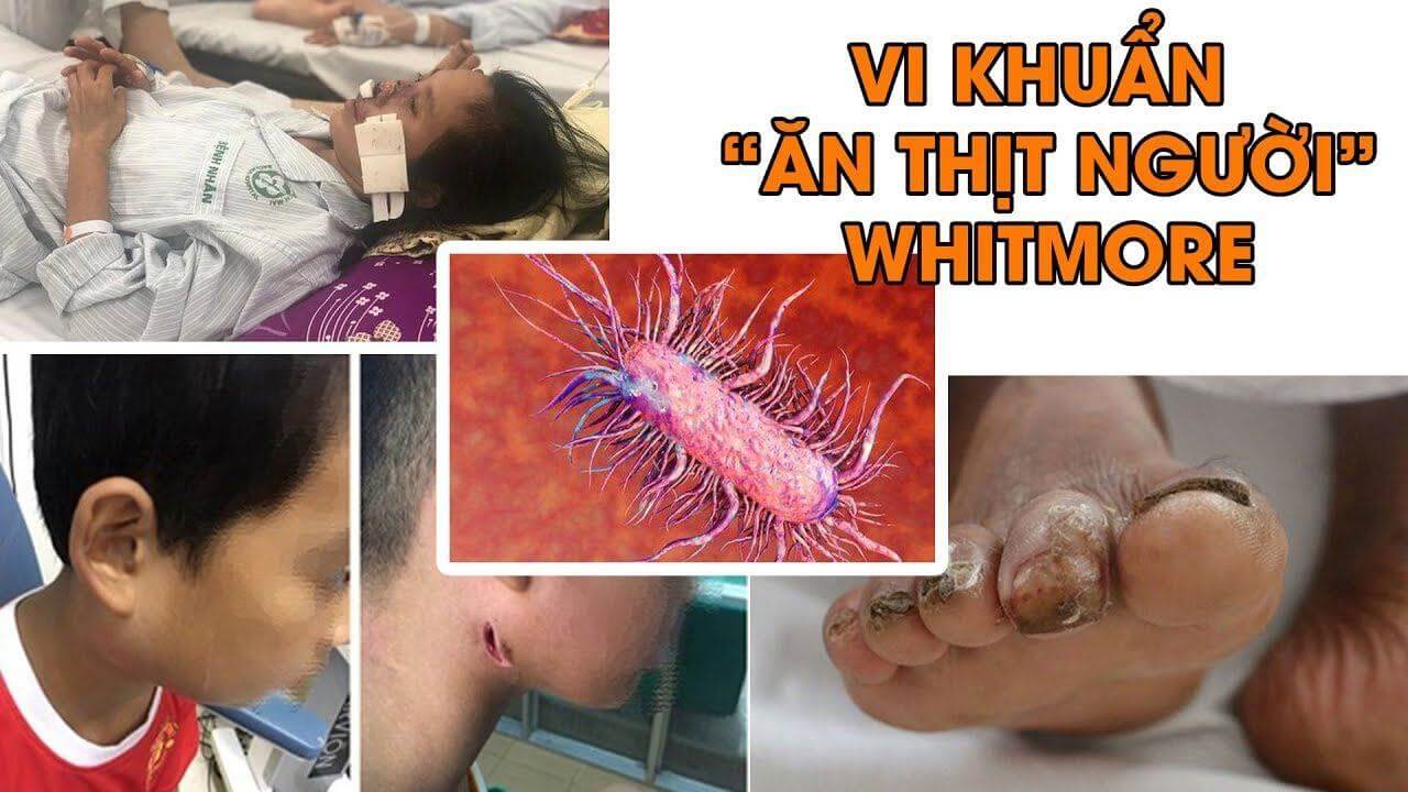 căn bệnh vi khuẩn ăn thịt người whitmore
