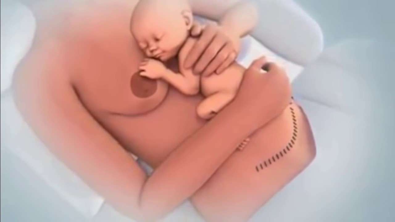 Bật mí cho mẹ bỉm thực đơn sau sinh mổ vừa lành, vừa dinh dưỡng! 17 Sinh mổ nên ăn gì?