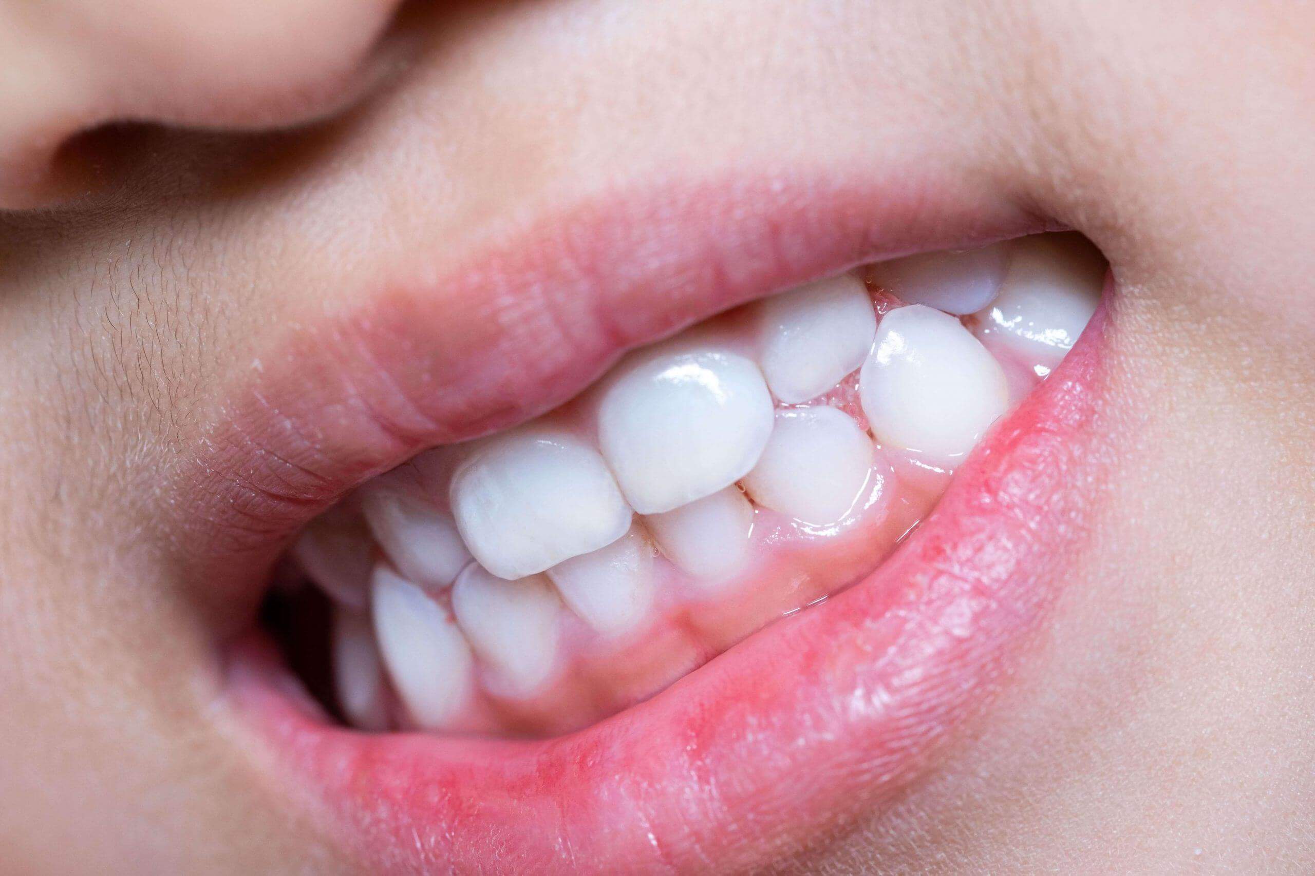 Bác sĩ nha khoa mách mẹ thời điểm "vàng" niềng răng cho trẻ 37 răng đẹp