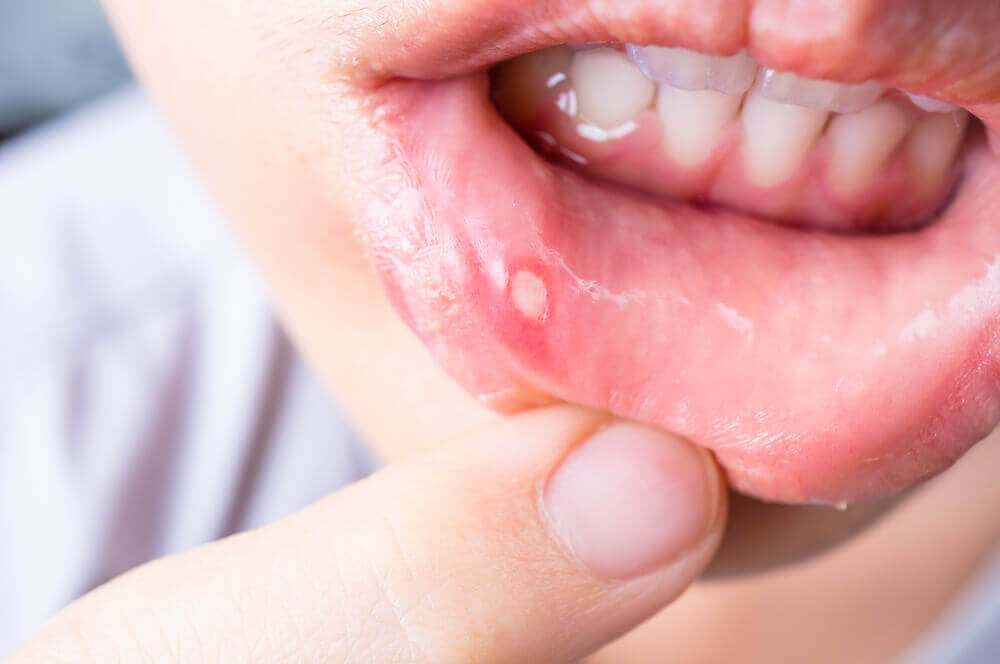 10 cách chữa nhiệt miệng hiệu quả, mẹ bỏ túi "bí kíp" ngay và luôn nhé! 38 chữa nhiệt miệng