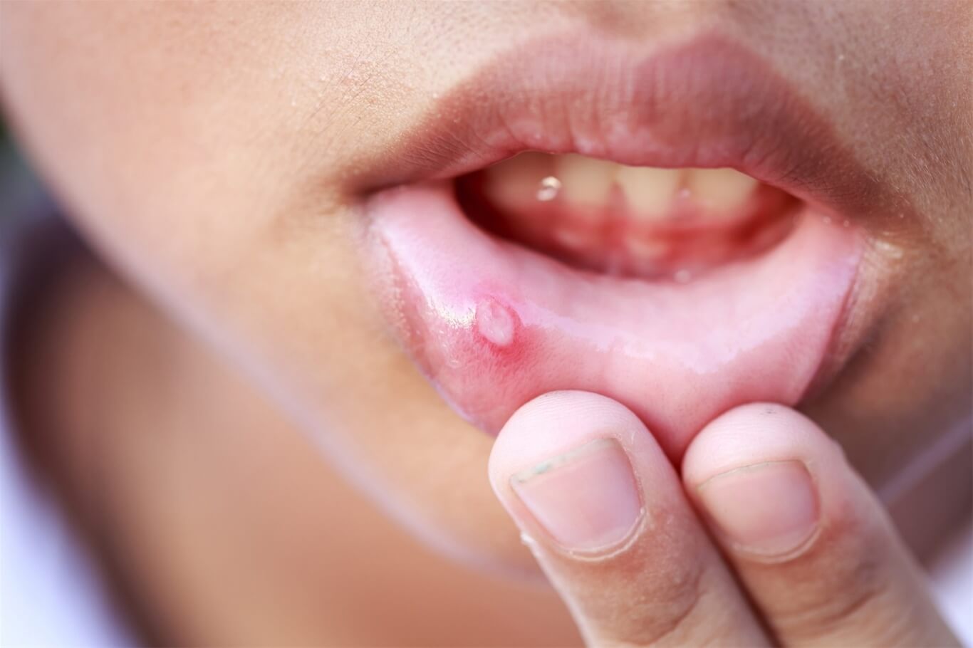 10 cách chữa nhiệt miệng hiệu quả, mẹ bỏ túi "bí kíp" ngay và luôn nhé! 40 nhiệt miệng