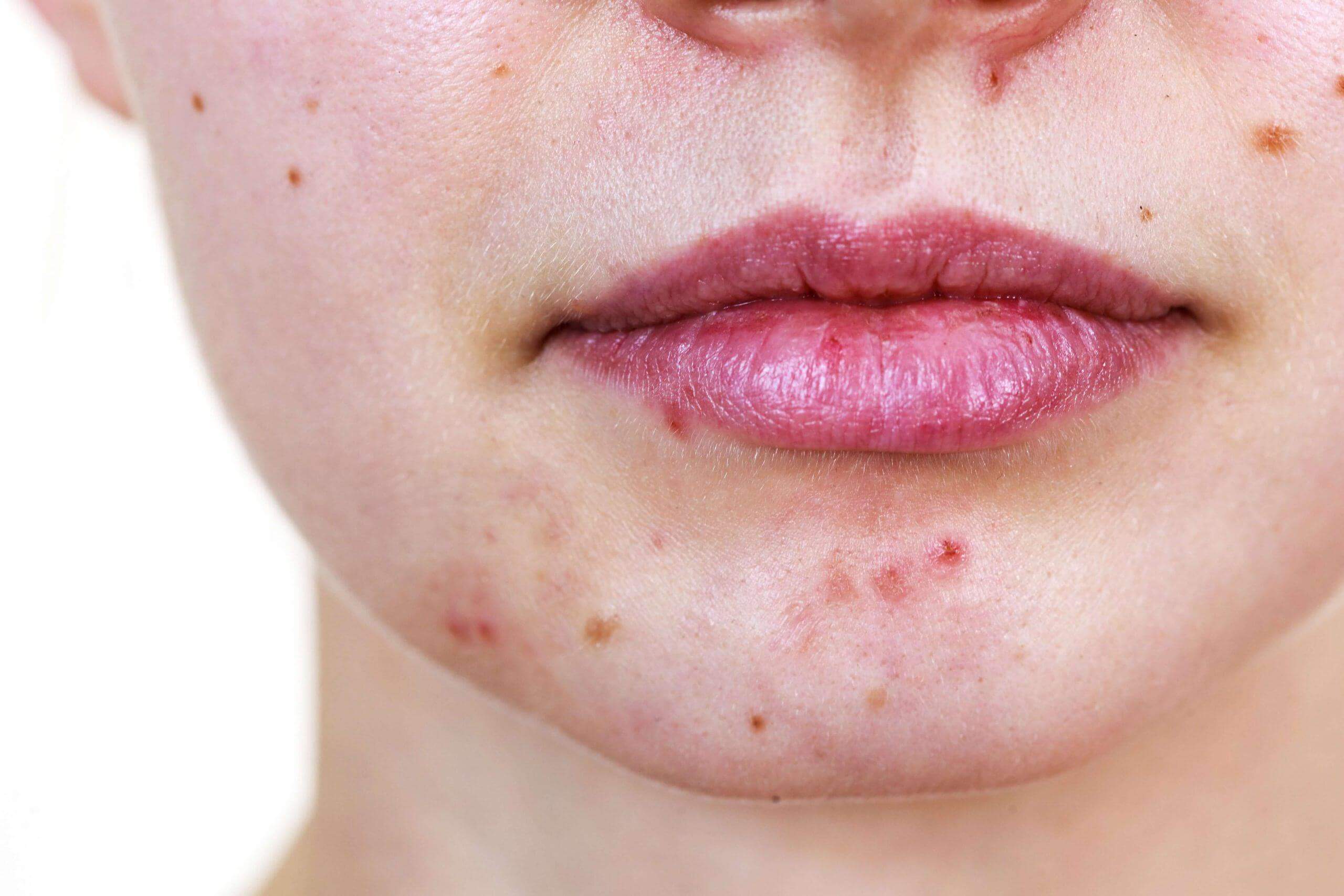 Vị trí mụn nói lên điều gì về sức khỏe, chị em cùng khám phá nhé! 43 mụn ở cằm