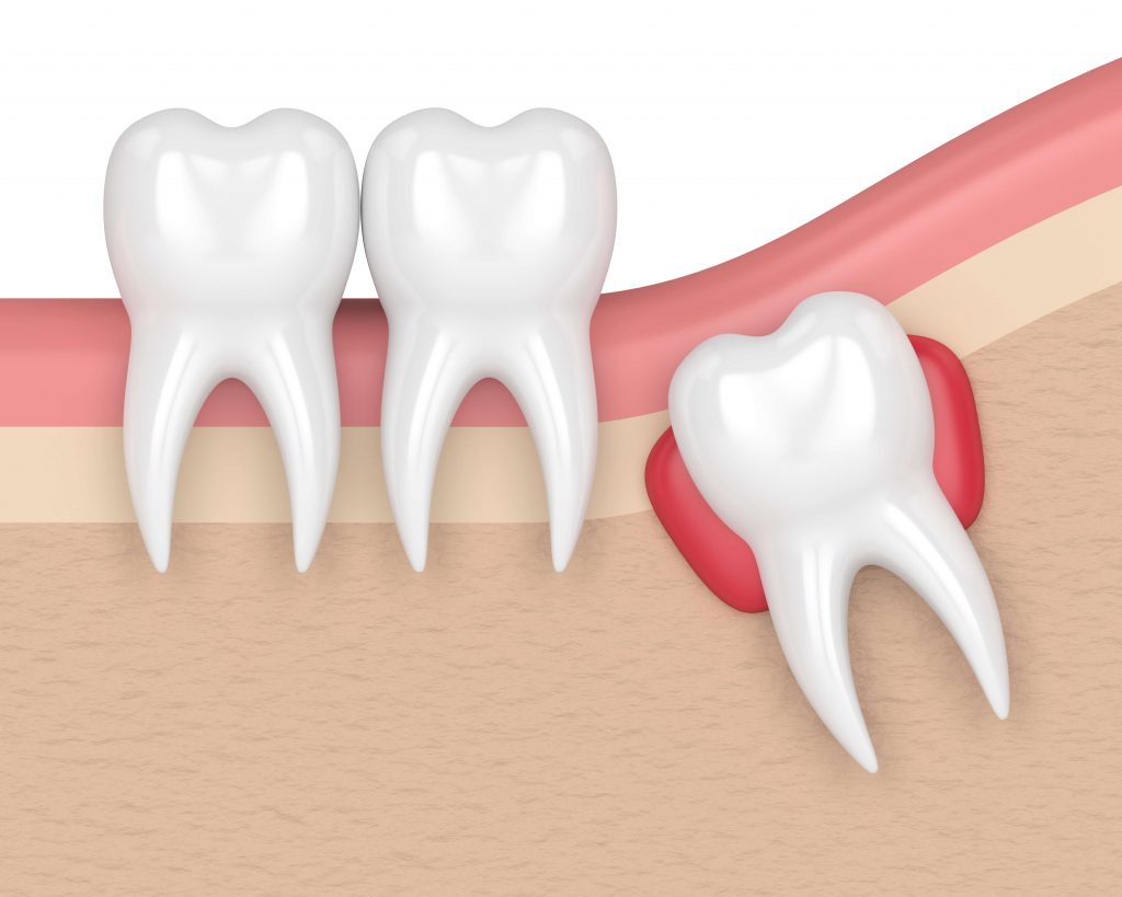 1.001 câu hỏi xoay quanh chuyện nhổ răng khôn ai cũng nên biết 38 nhổ răng khôn