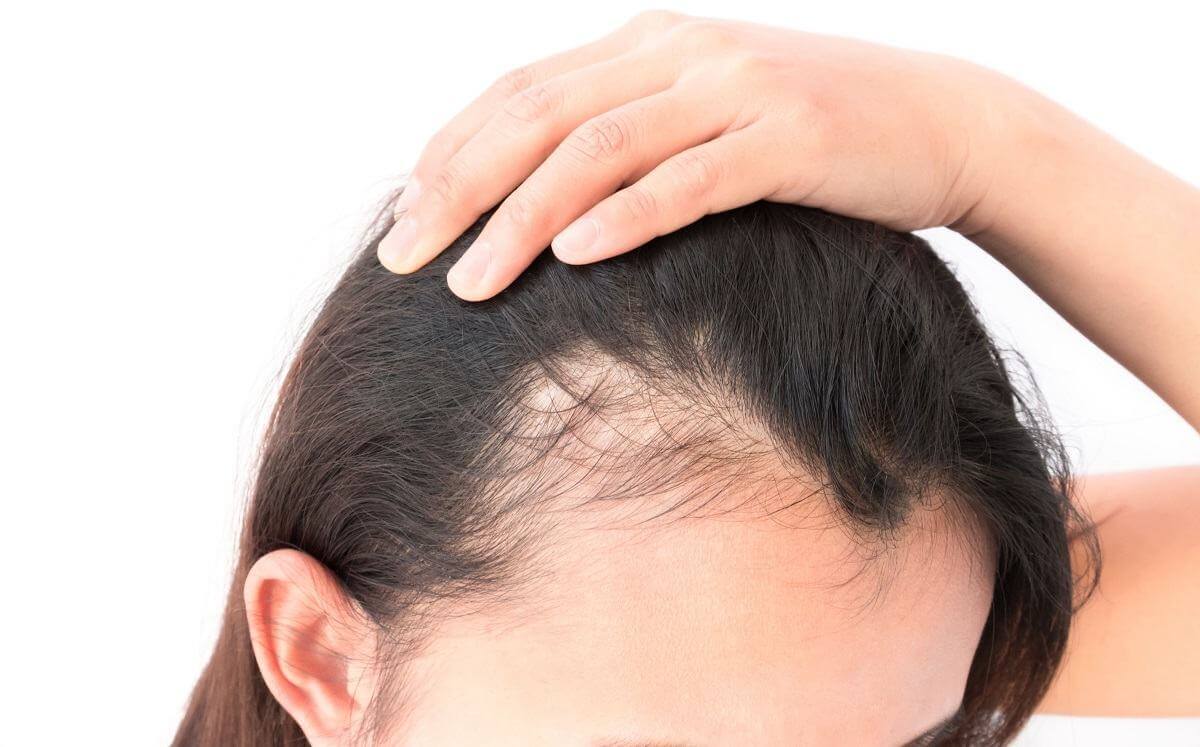 hói đầu rụng tóc
