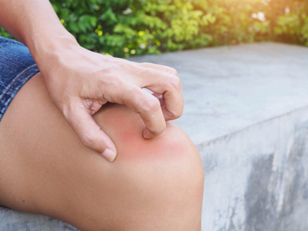 Mùa mưa, cùng tìm hiểu về kiến ba khoang để bảo vệ gia đình 36 xử trí vết cắn kiến ba khoang