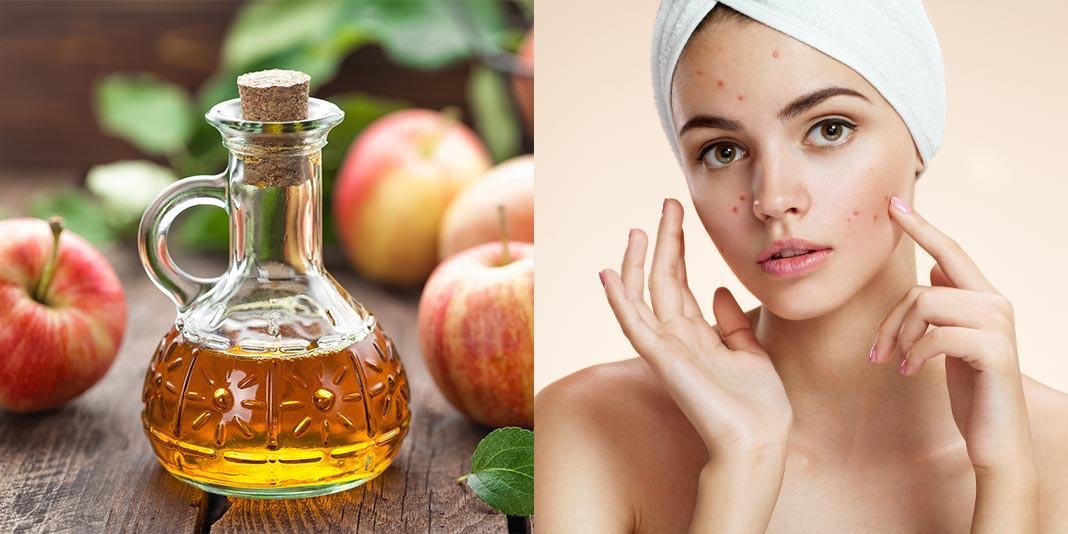 Tự làm 6 loại mặt nạ trị mụn tại nhà an toàn, hiệu quả 39 giấm táo trị mụn