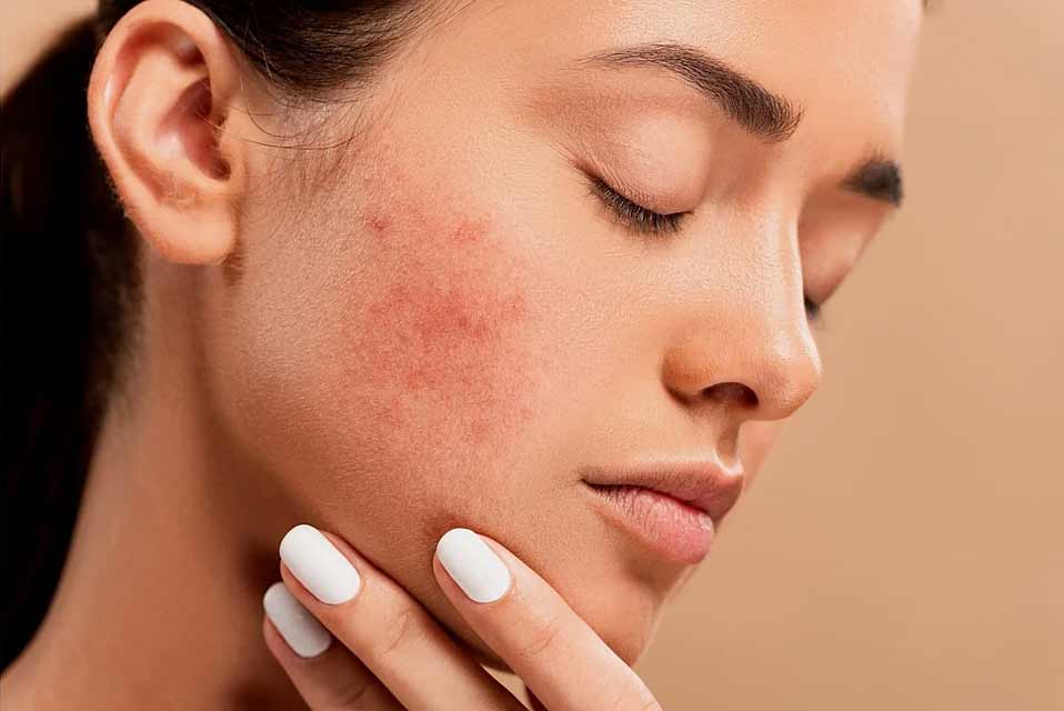 Tự làm 6 loại mặt nạ trị mụn tại nhà an toàn, hiệu quả 36 trị mụn tại nhà