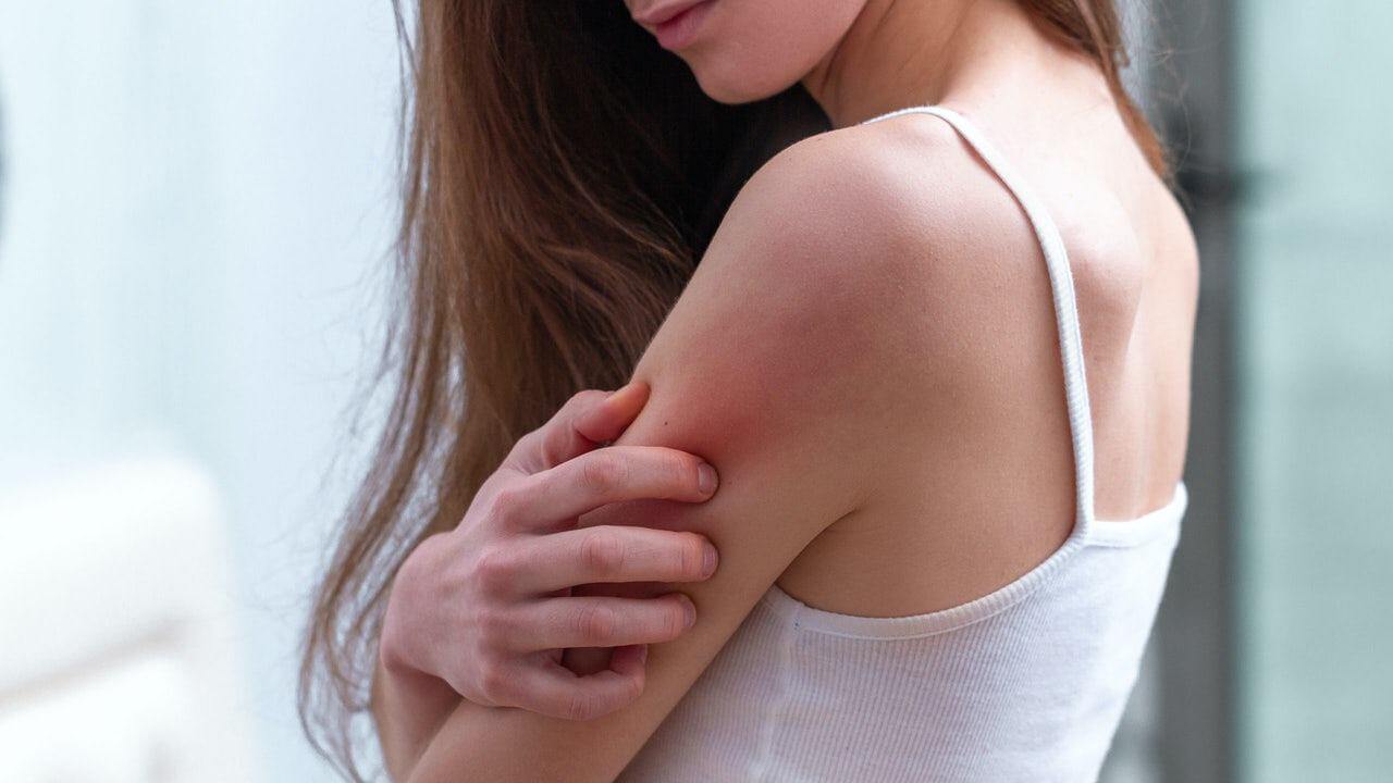 Đừng vội hốt hoảng với "Cánh tay Covid" sau khi tiêm vaccine 36 cánh tay covid