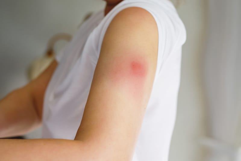 Đừng vội hốt hoảng với "Cánh tay Covid" sau khi tiêm vaccine 37 cánh tay covid