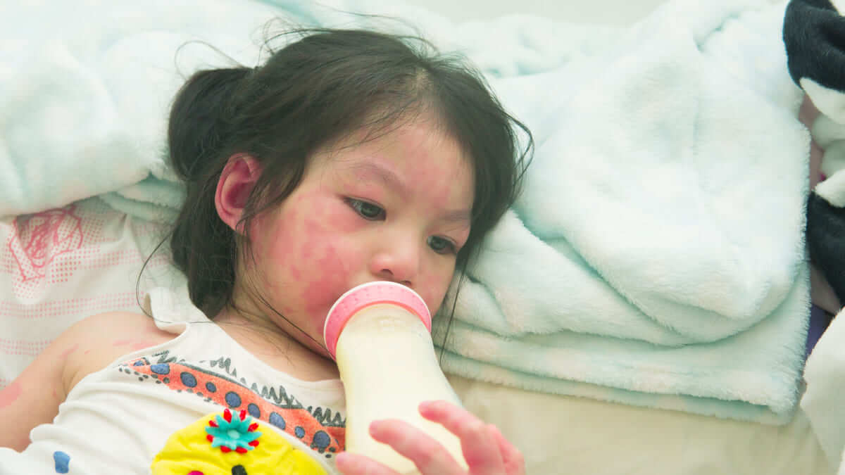 Trẻ bị dị ứng sữa có nguy hiểm không? 36 trẻ bị dị ứng sữa