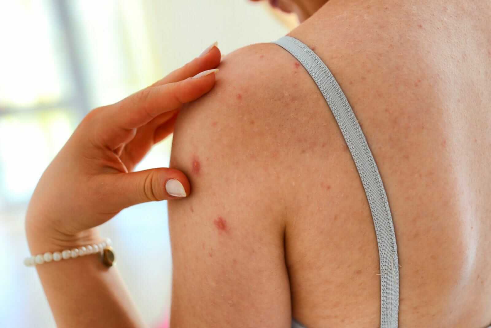 trị mụn lưng tại nhà