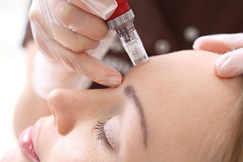 "Lão hóa ngược" với Microneedling, bạn đã biết? 37 lăn kim vi điểm