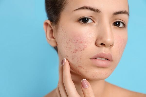 Căng thẳng là "thủ phạm" tàn phá nhan sắc chị em 35 căng thẳng