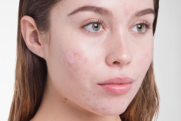 Căng thẳng là "thủ phạm" tàn phá nhan sắc chị em 36 căng thẳng gây nổi mụn