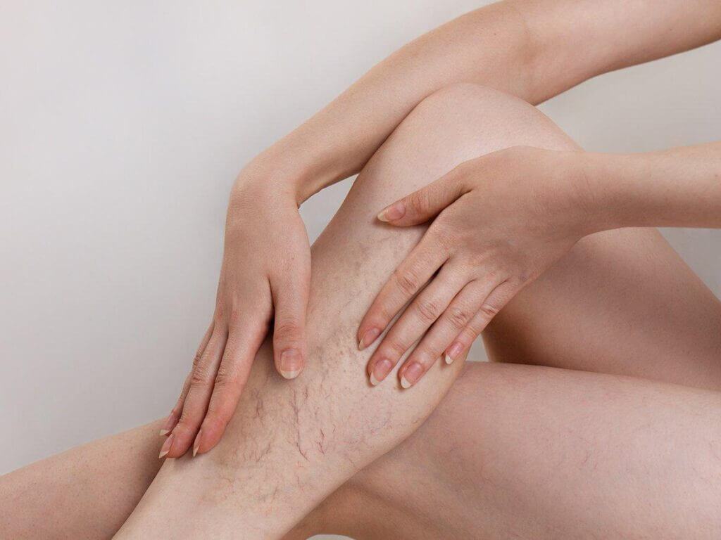 giãn tĩnh mạch