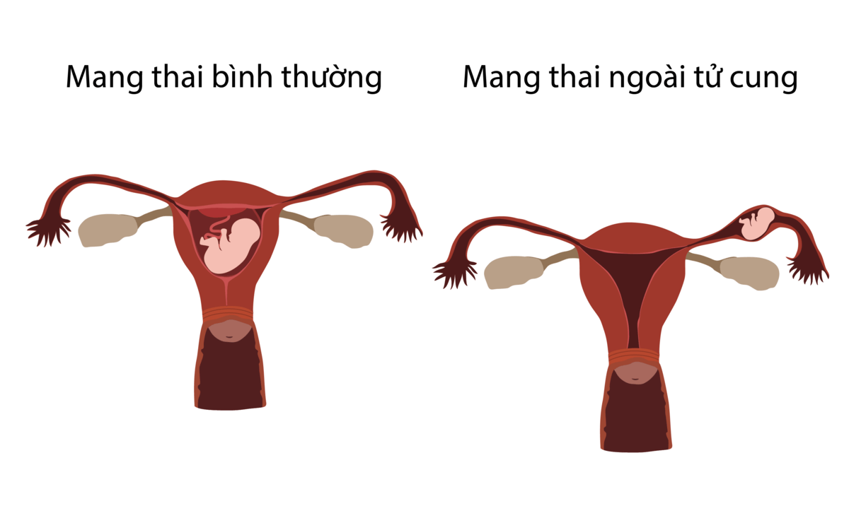 thai ngoài tử cung