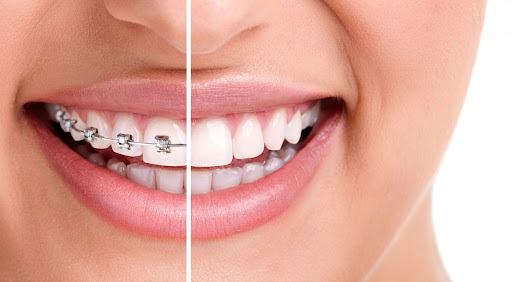 Niềng răng bị hóp má: Nguyên nhân và cách khắc phục 34 Niềng răng
