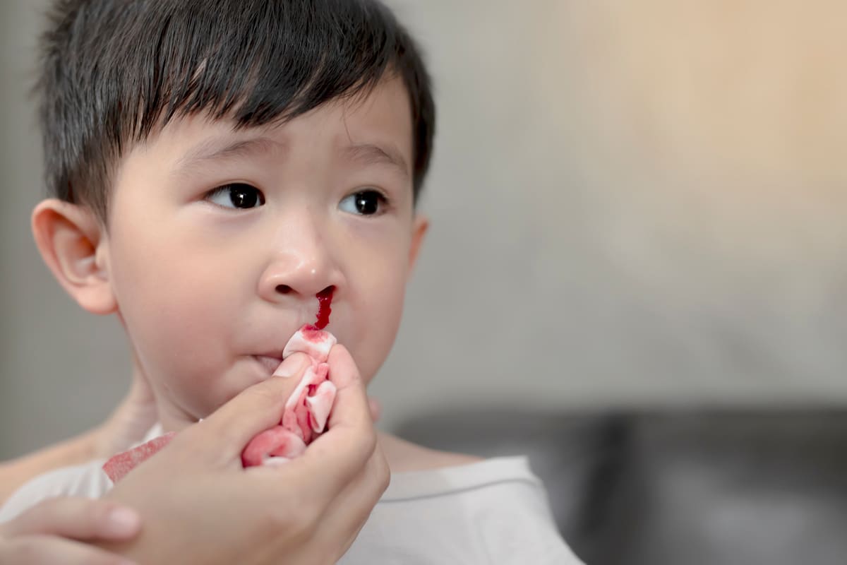 Vì sao trẻ bị chảy máu cam và mách mẹ 5 mẹo tránh tái phát 36 Trẻ bị chảy máu cam