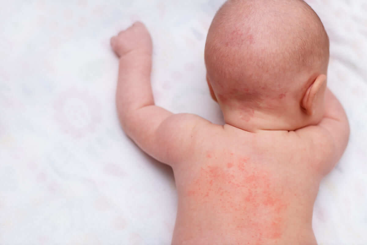 Trẻ bị sốt phát ban, ba mẹ đừng quên những cách xử lý sau đây nhé! 35 trẻ bị sốt phát ban