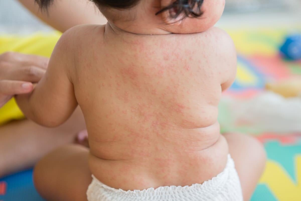 Trẻ bị sốt phát ban, ba mẹ đừng quên những cách xử lý sau đây nhé! 37 chăm sóc trẻ bị sốt phát ban