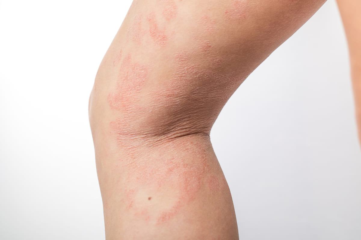 Viêm da dị ứng do cơ địa từ nay sẽ không còn làm mẹ đau đầu nữa 37 Viêm da dị ứng do tiếp xúc