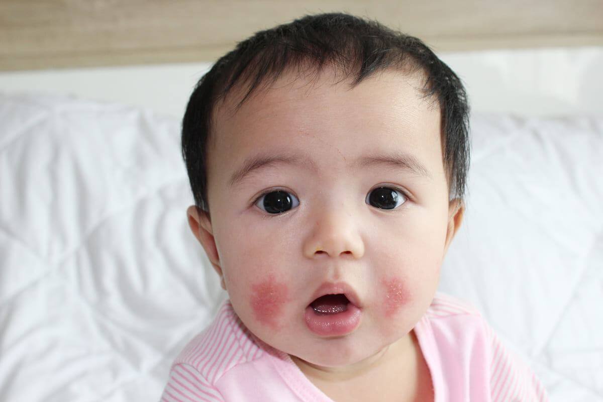 Viêm da dị ứng do cơ địa từ nay sẽ không còn làm mẹ đau đầu nữa 36 Viêm da dị ứng do cơ địa 2